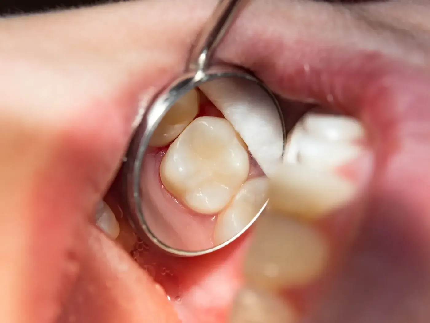 Tooth-colored dental filling treatment at Charming Smiles of Ocoee