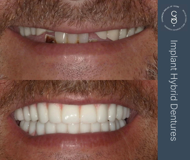 Implant Hybrid Dentures before and after